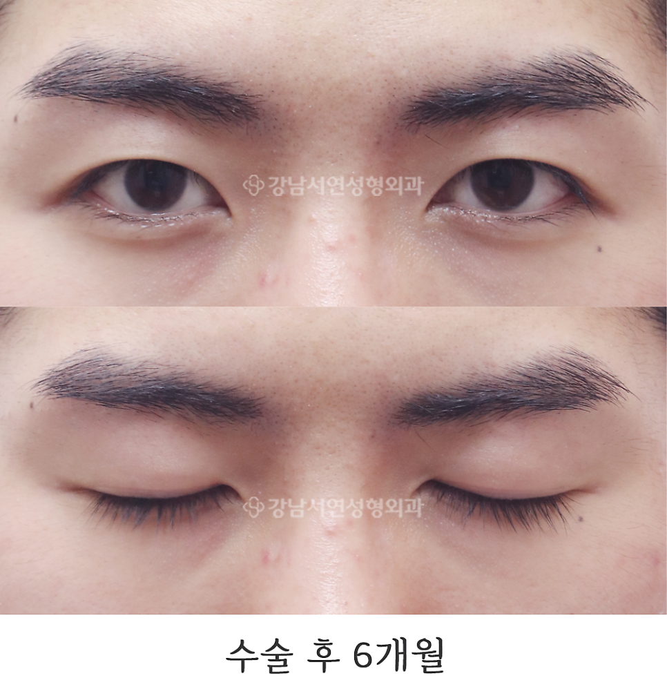 남자 눈성형 수술 후 사진
