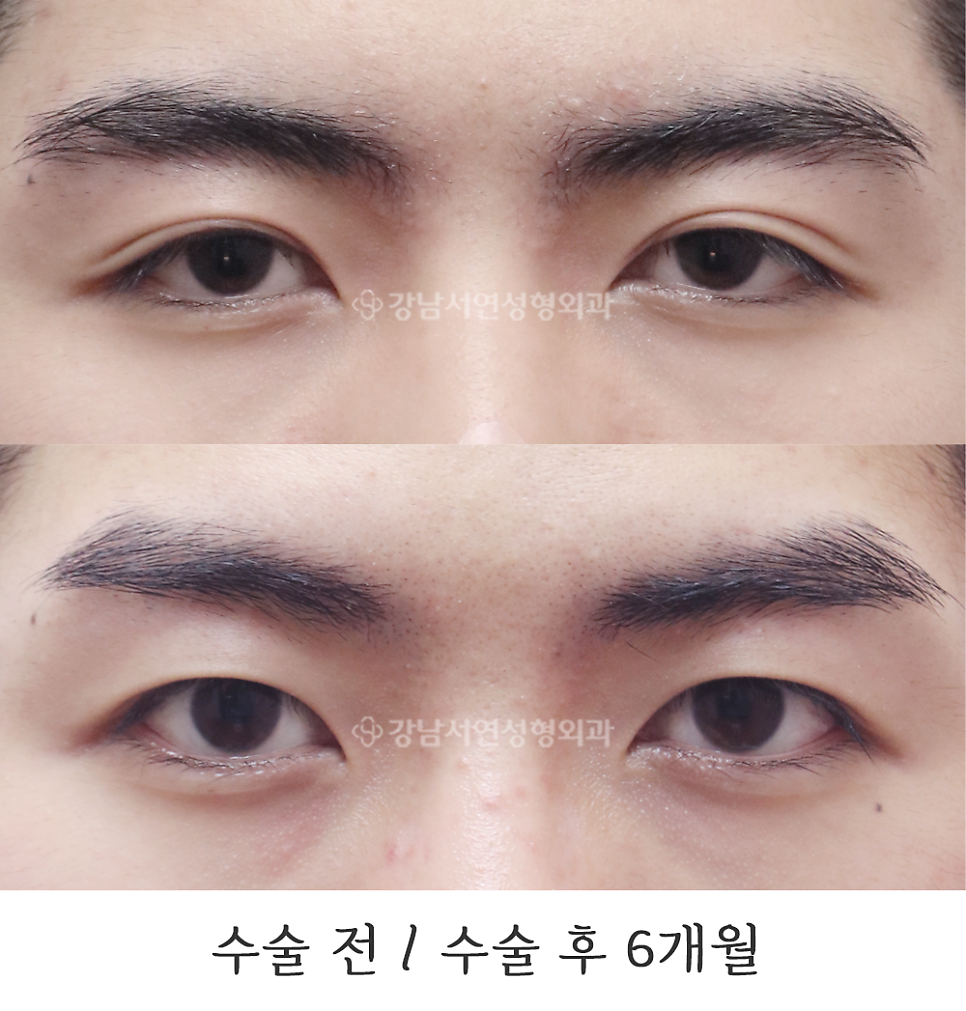 남자 눈성형 수술 전후 비교 사진