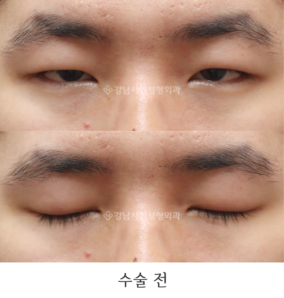 남자 눈성형 수술 전 사진