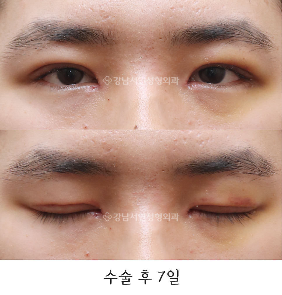 남자 눈성형 수술 후 사진