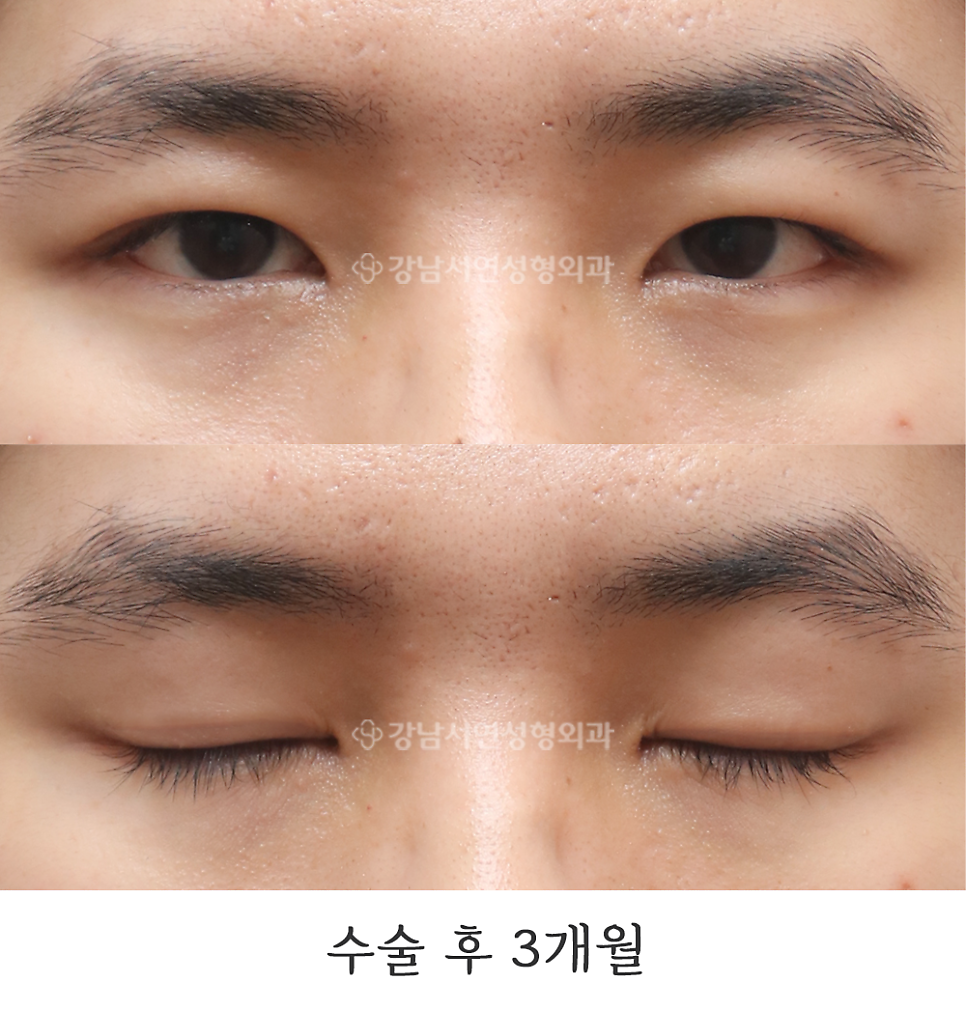 남자 눈성형 수술 후 사진