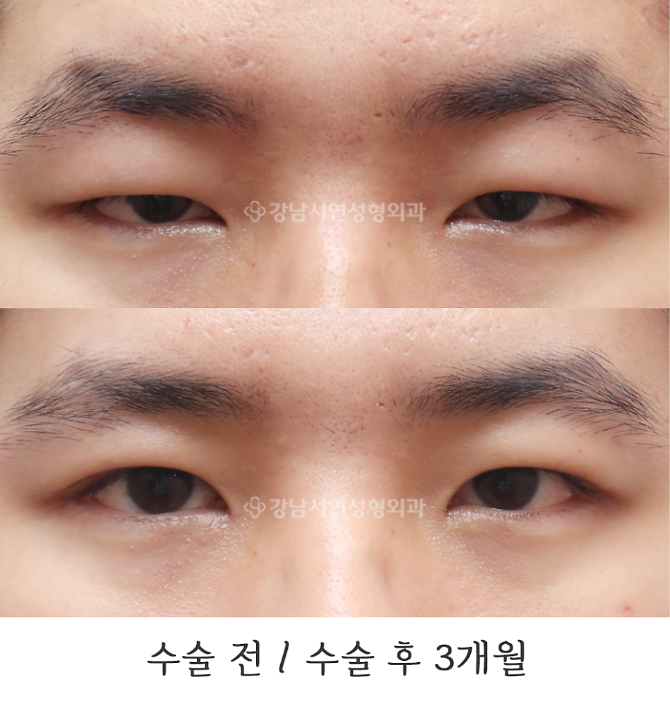 남자 눈성형 수술 전후 비교 사진