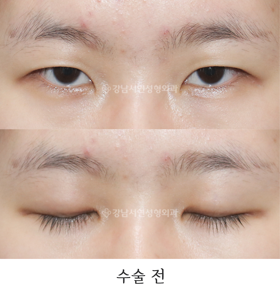 눈매 트임 수술 전 사진