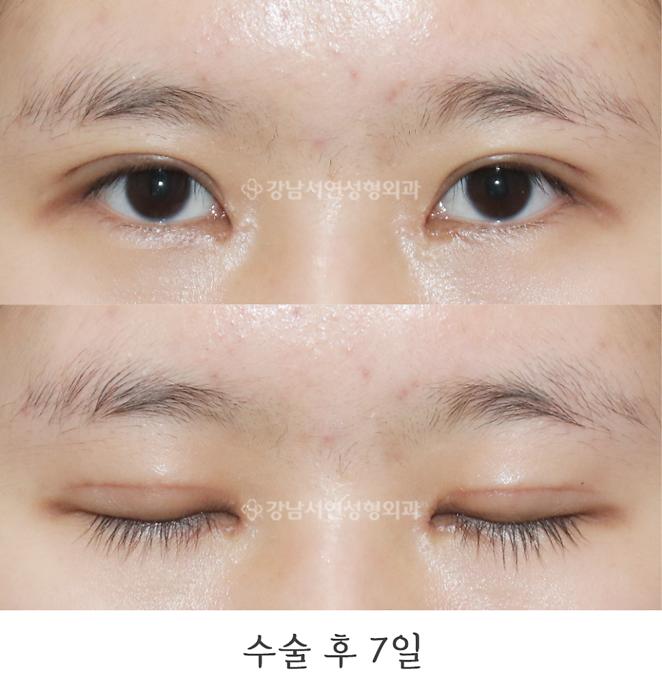 눈매 트임 수술 후 사진