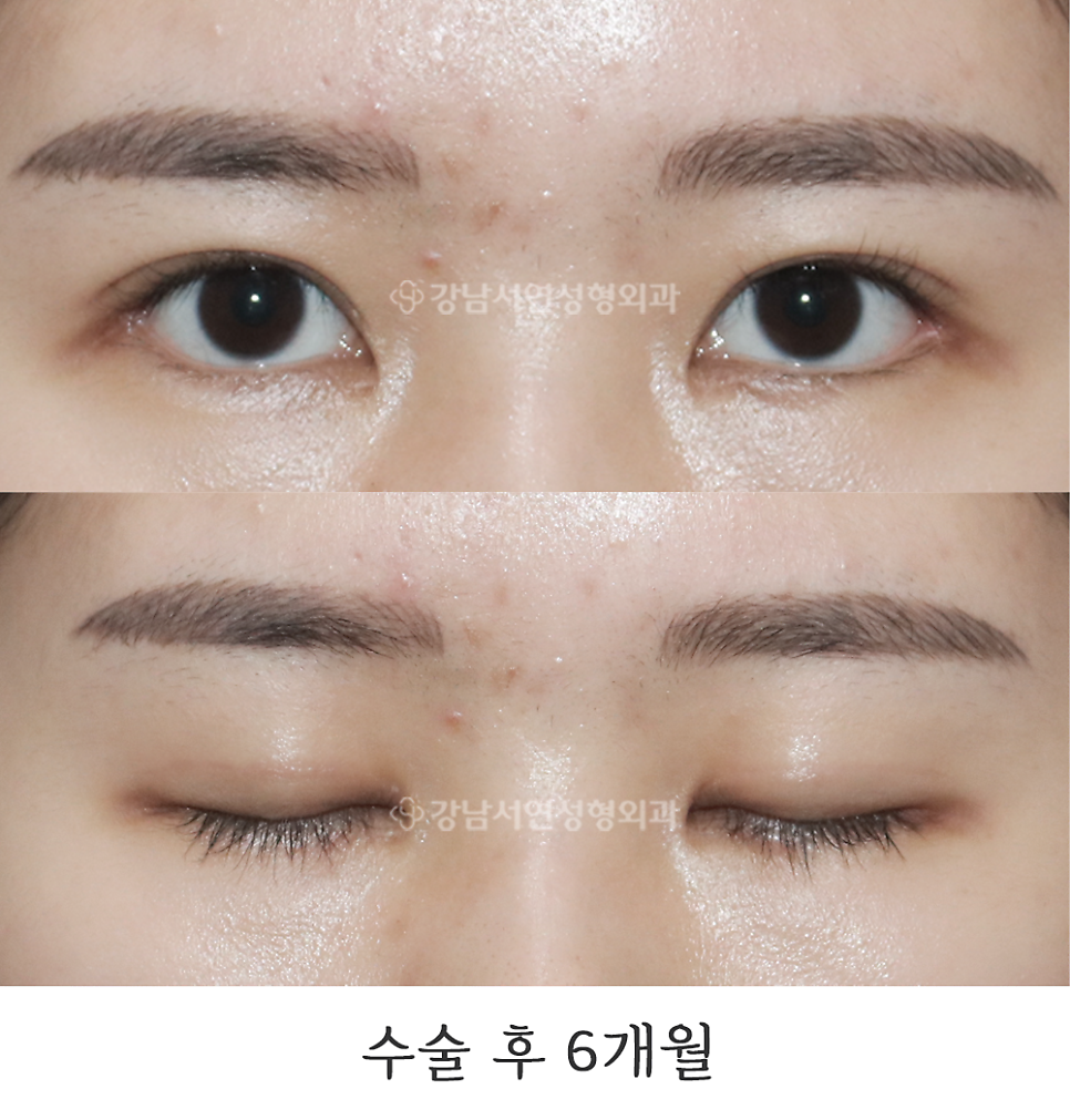 눈매 트임 수술 후 사진