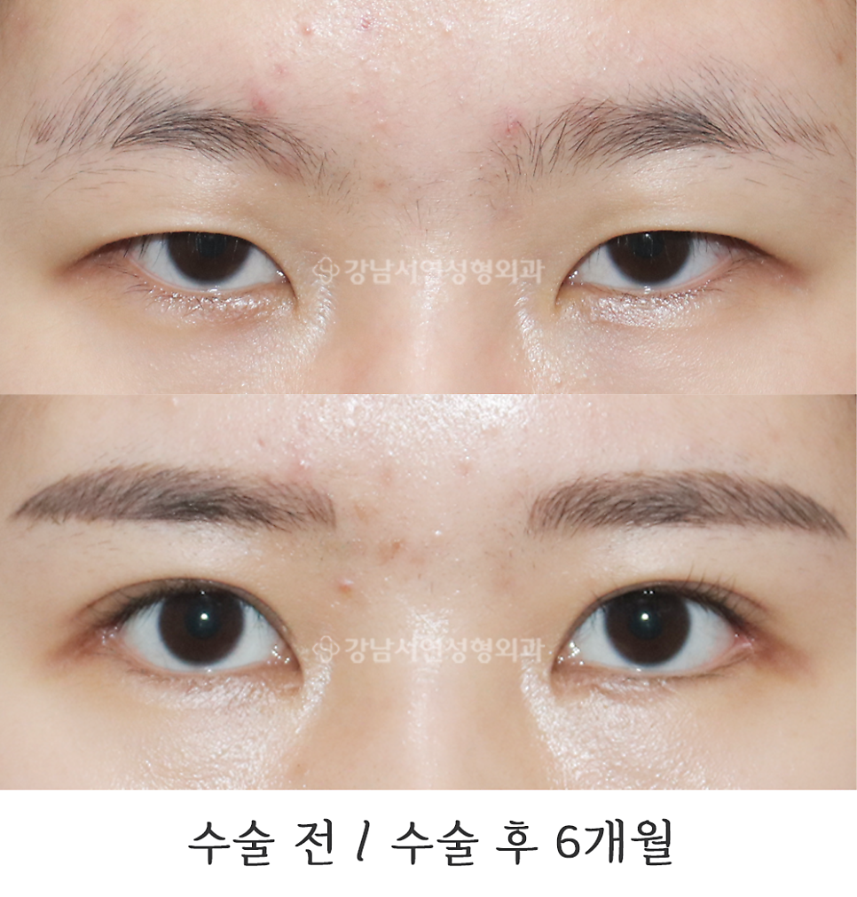 눈매 트임 수술 전후 비교 사진