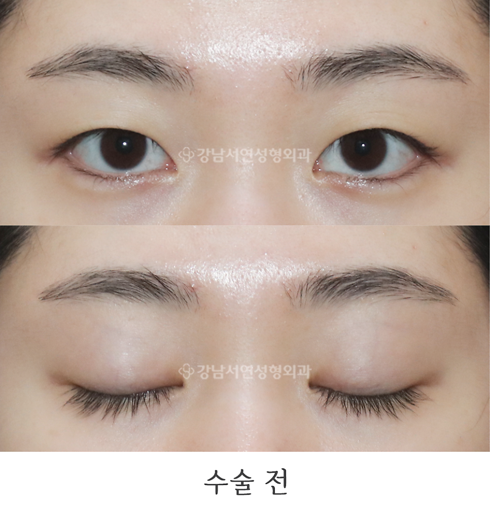 매몰실풀기 수술 전 사진