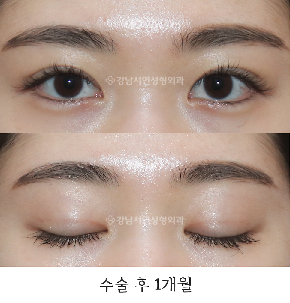 매몰실풀기 수술 후 사진