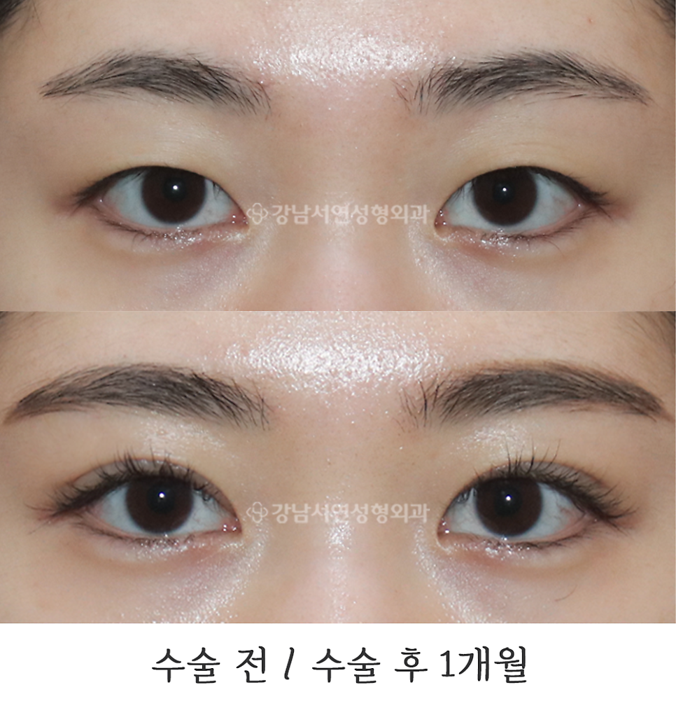 매몰실풀기 수술 전후 비교 사진