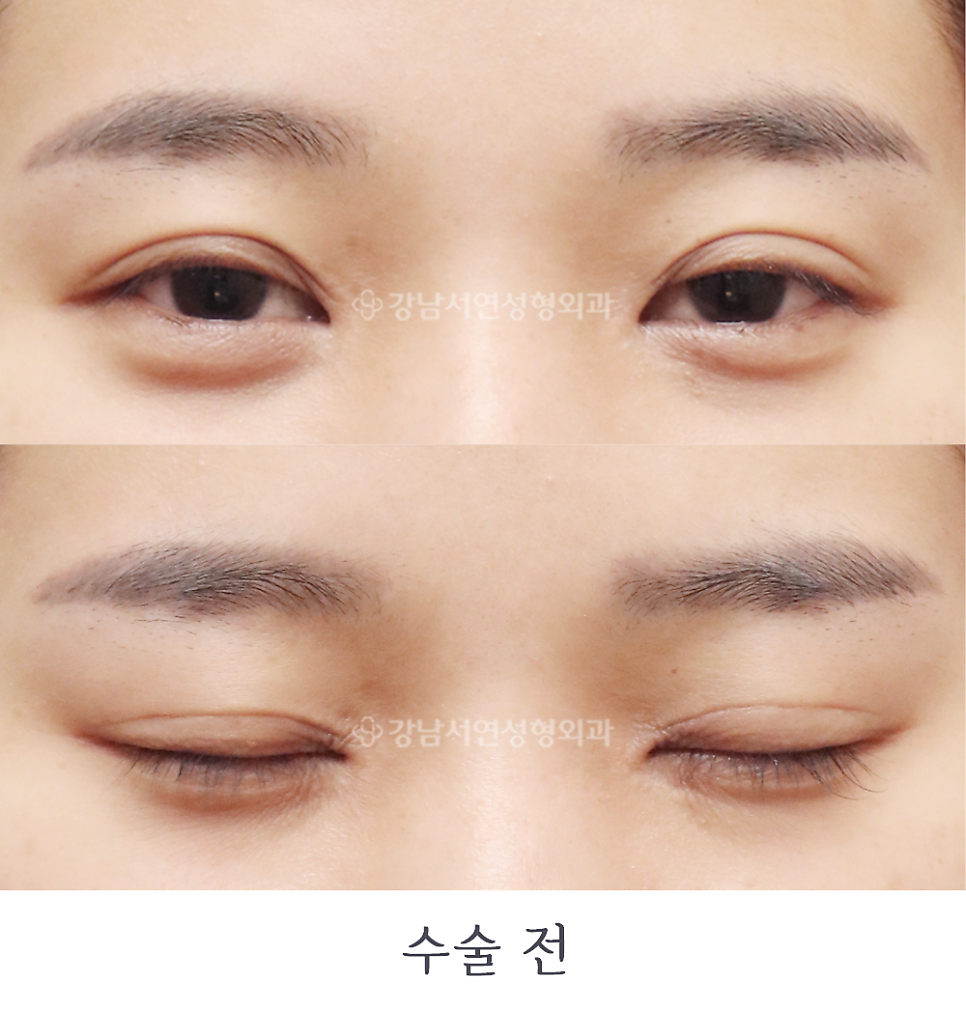 쌍꺼풀 재수술 전 사진