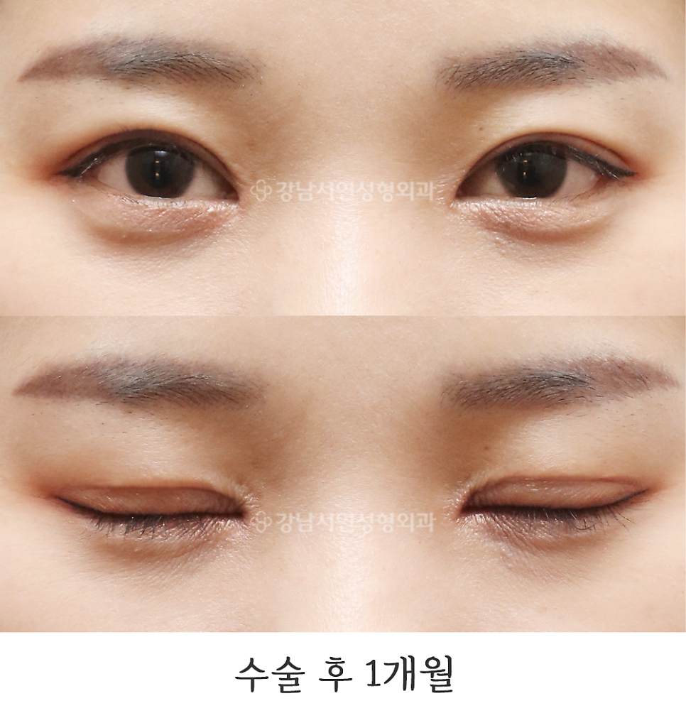 쌍꺼풀 재수술 후 사진