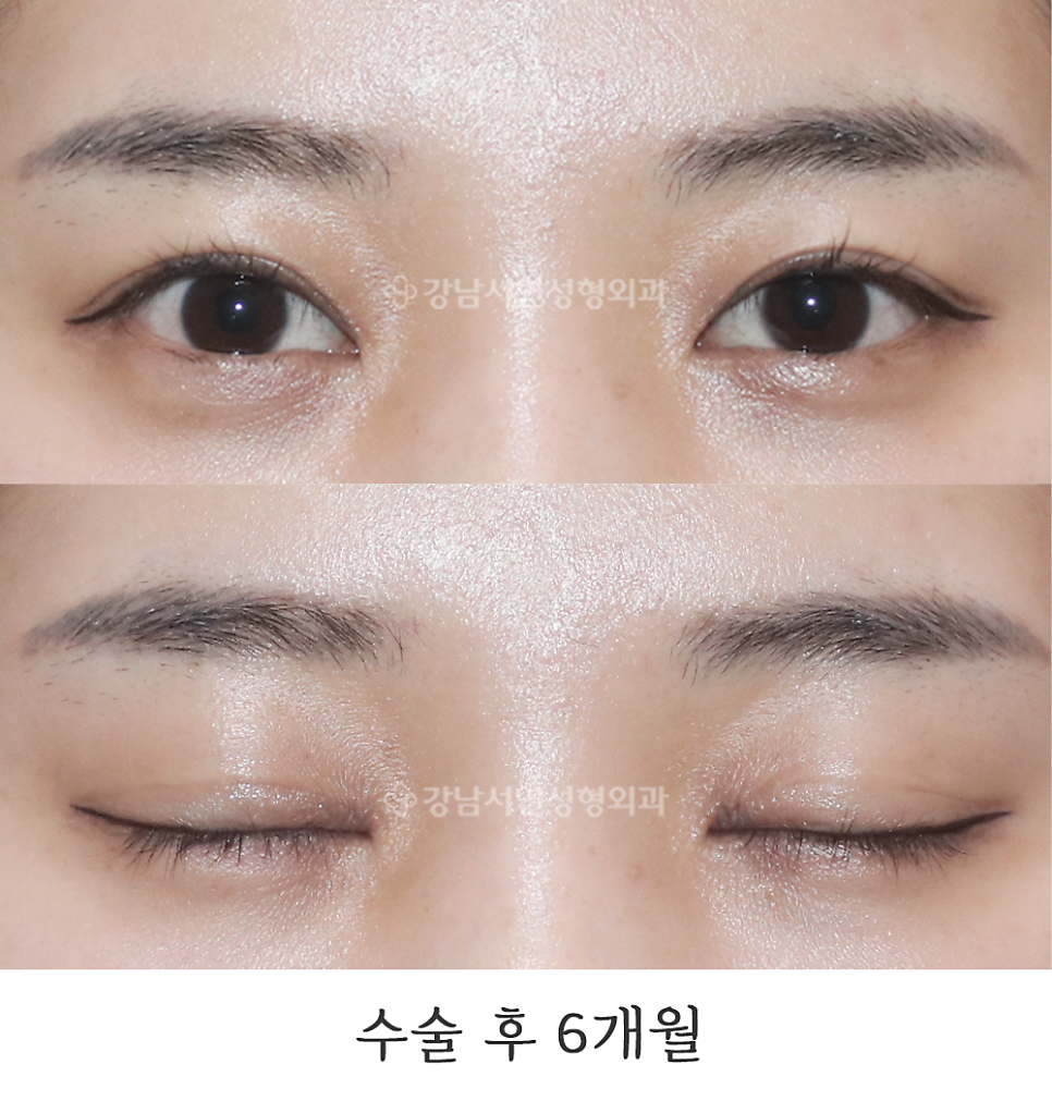 쌍꺼풀 재수술 후 사진