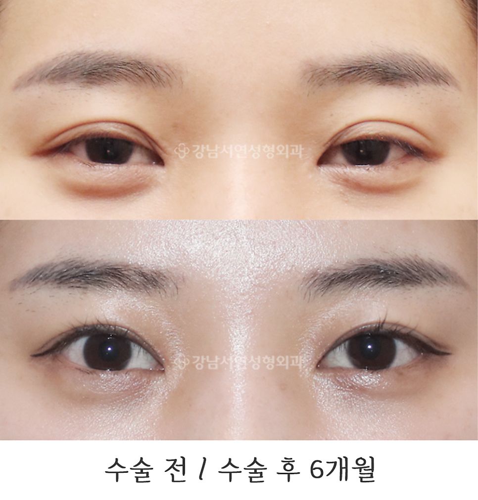 쌍꺼풀 재수술 전후 비교 사진