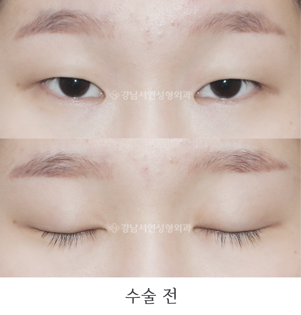 눈매 트임 수술 전 사진
