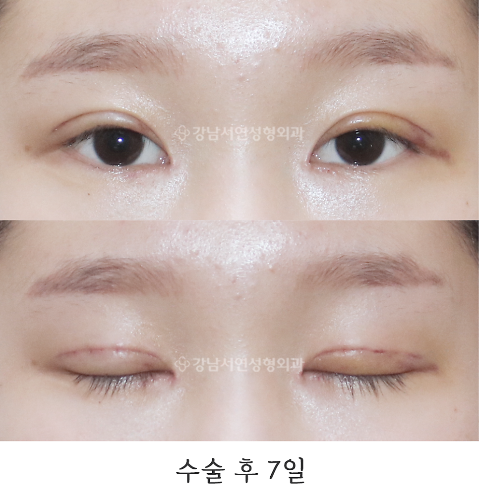 눈매 트임 수술 후 사진