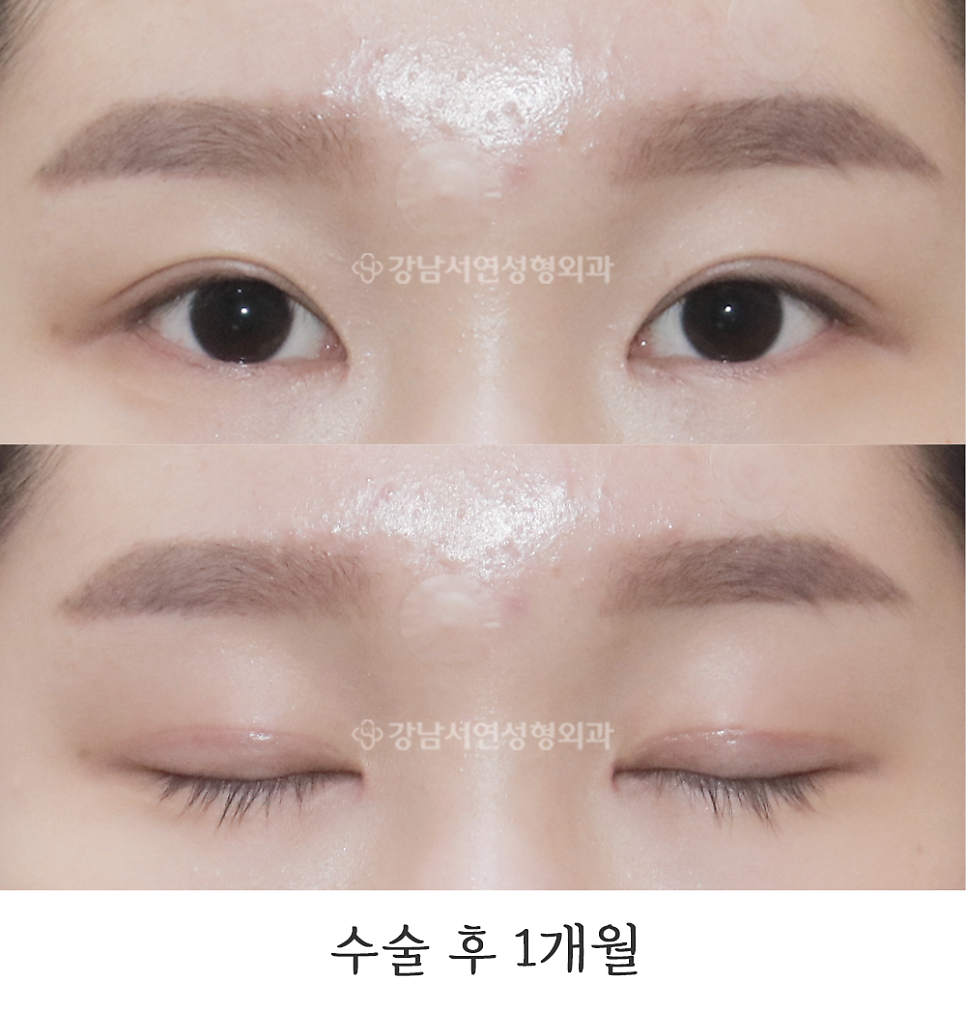 눈매 트임 수술 후 사진