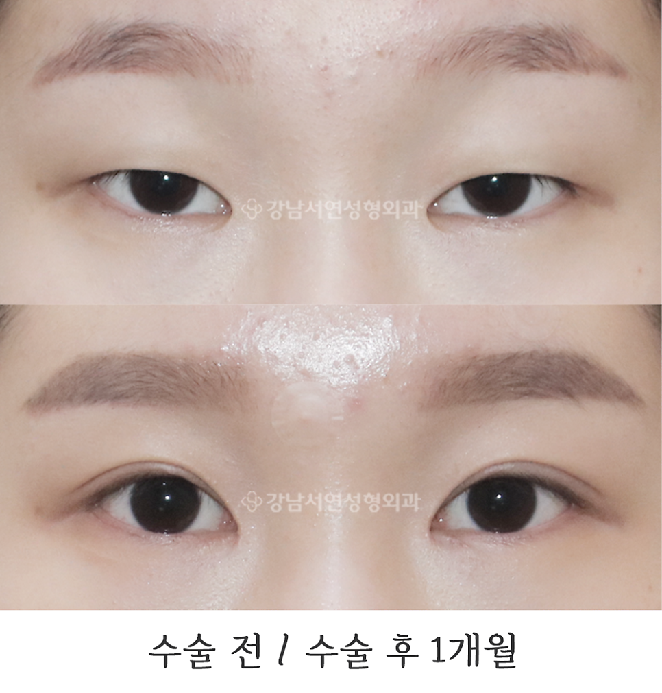 눈매 트임 수술 전후 비교 사진