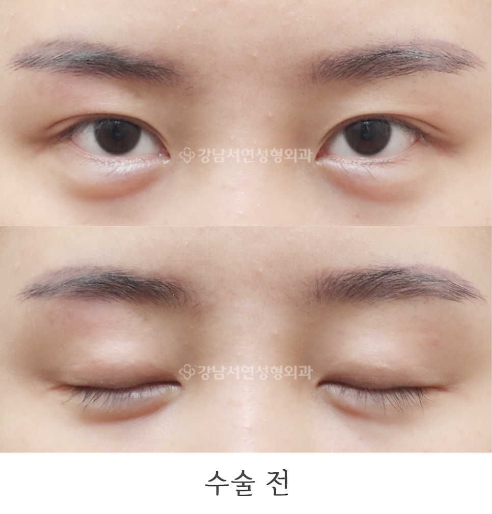 쌍꺼풀 재수술 전 사진