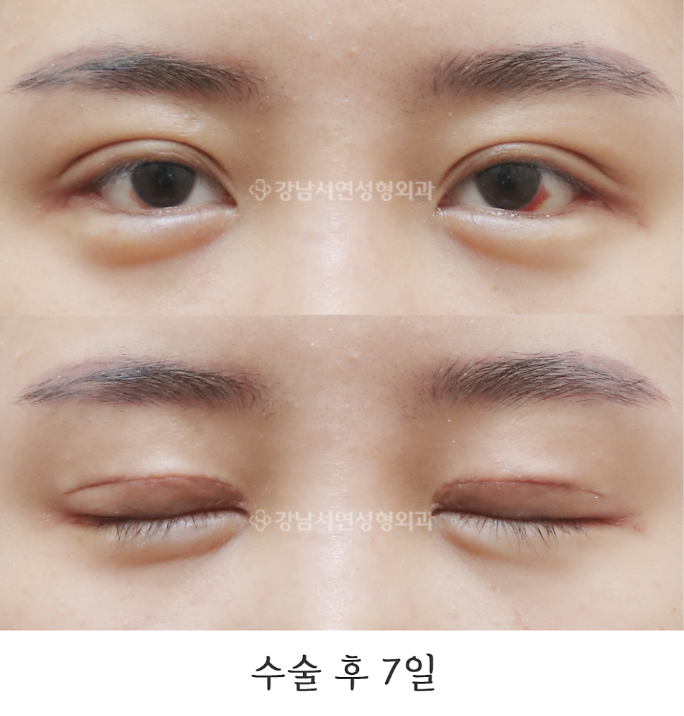 쌍꺼풀 재수술 후 사진