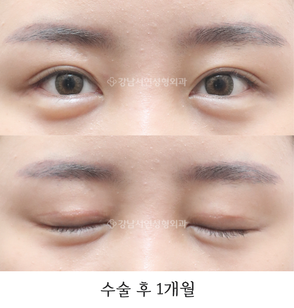 쌍꺼풀 재수술 후 사진