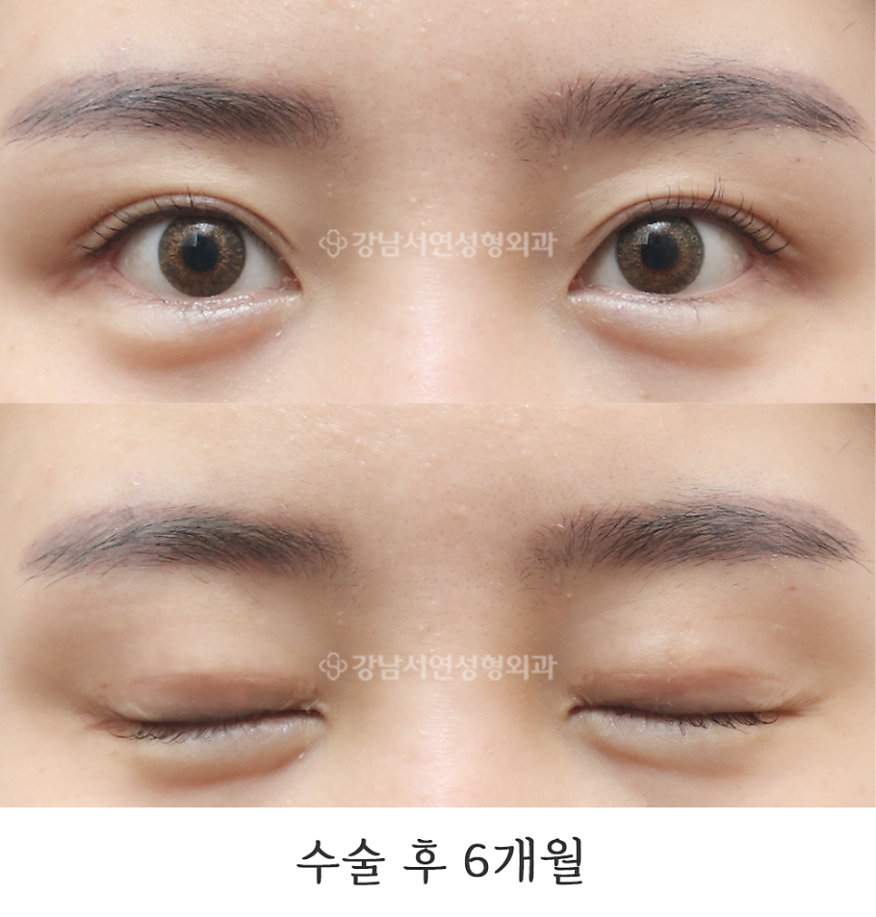 쌍꺼풀 재수술 후 사진