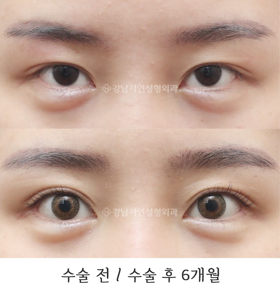 쌍꺼풀 재수술 전후 비교 사진