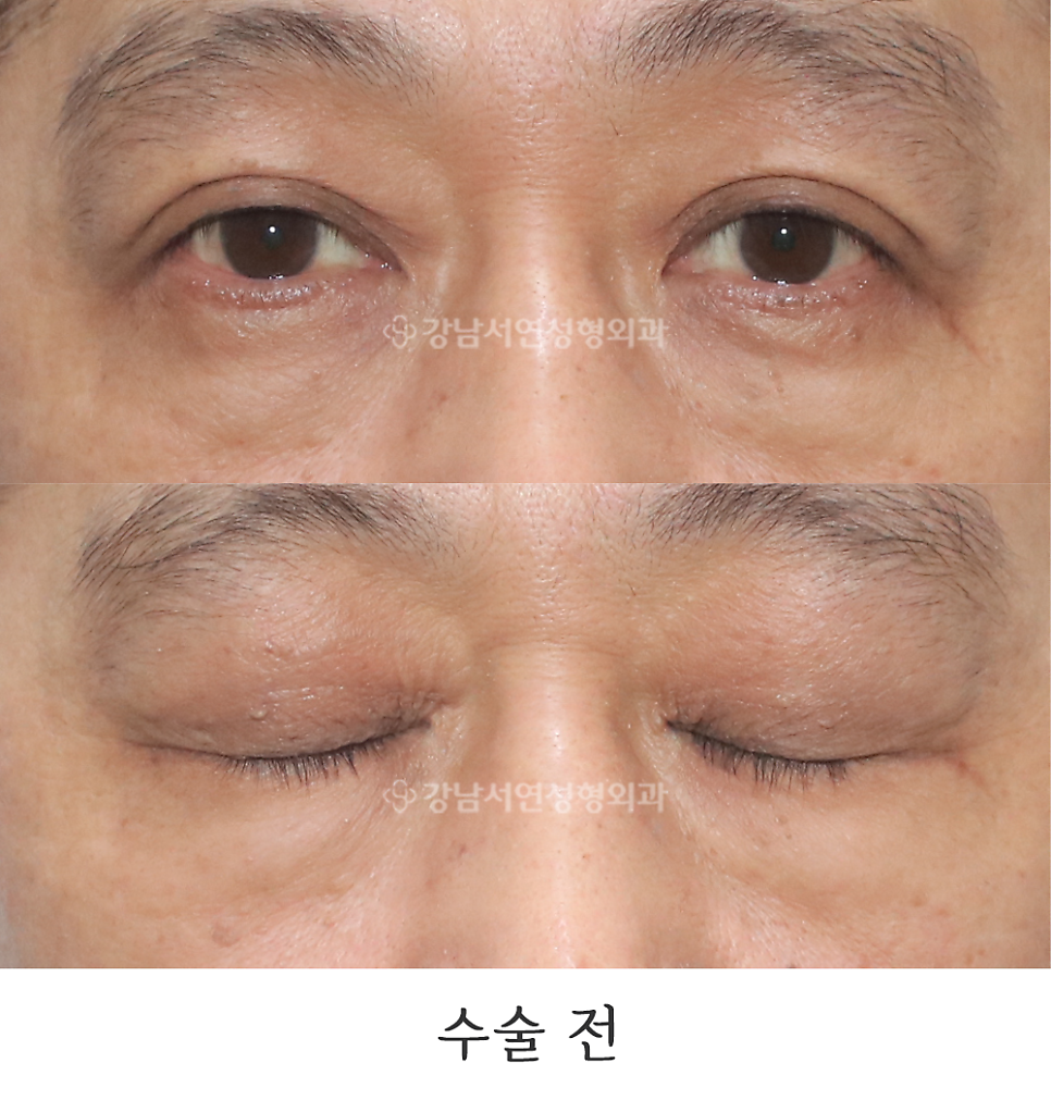 눈매교정 수술 전 사진