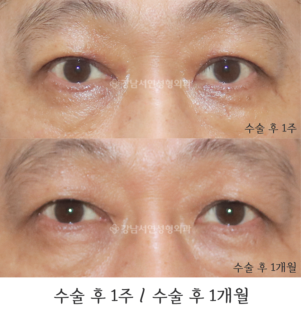 눈매교정 수술 전후 비교 사진