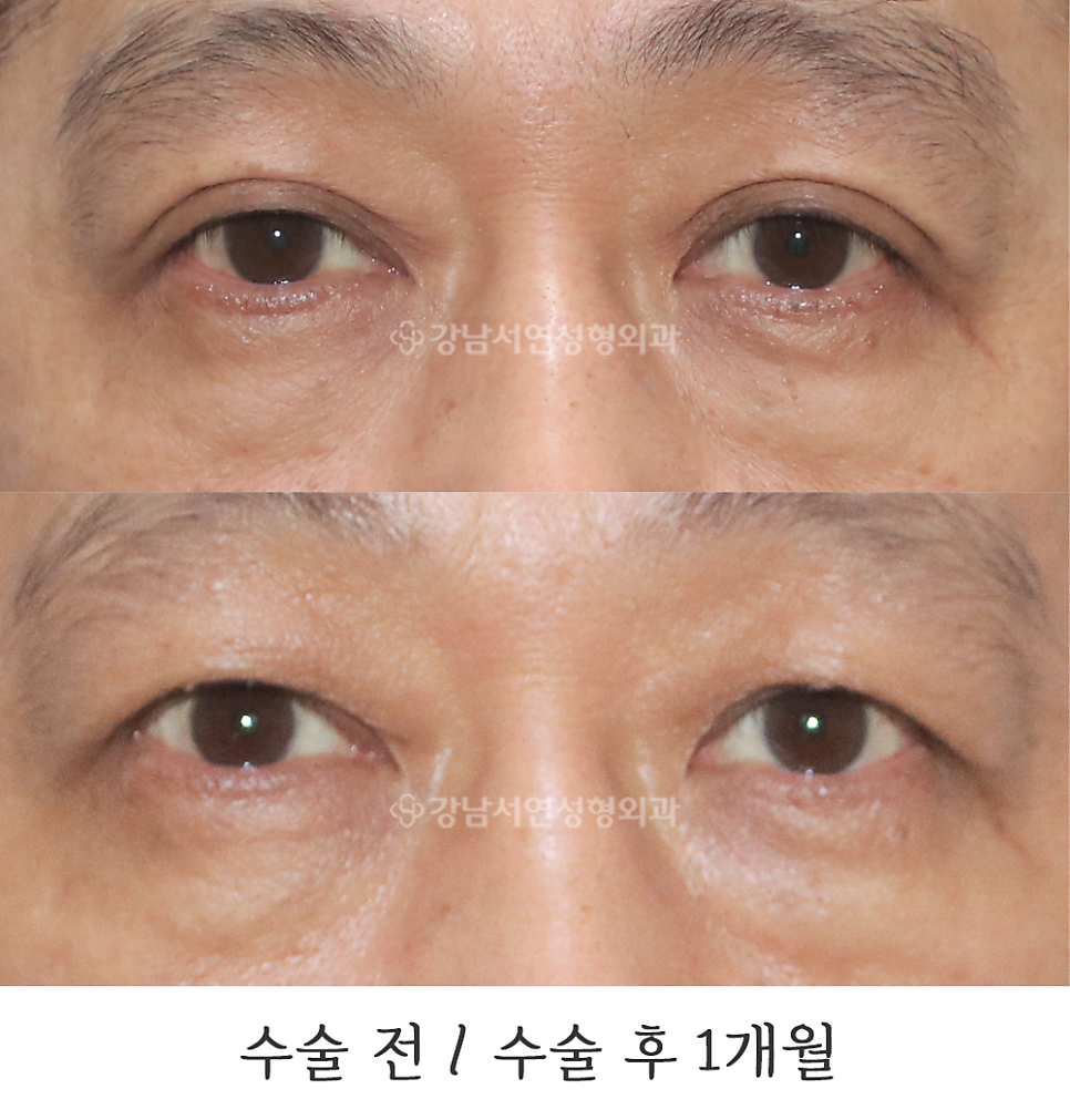눈매교정 수술 전후 비교 사진