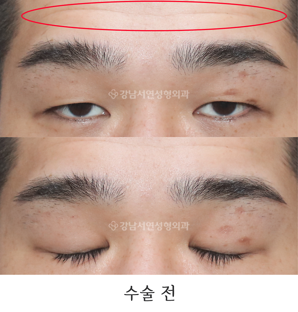남자 눈성형 수술 전 사진