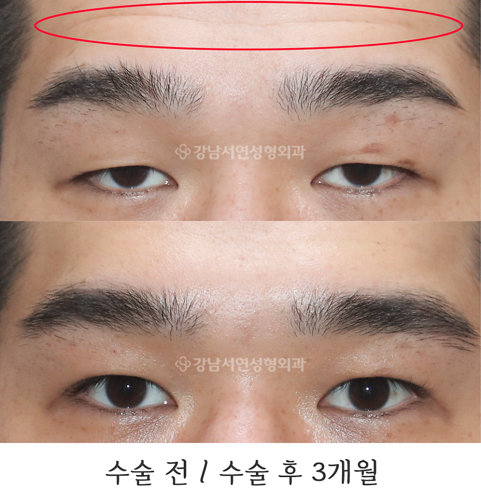 남자 눈성형 수술 전후 비교 사진
