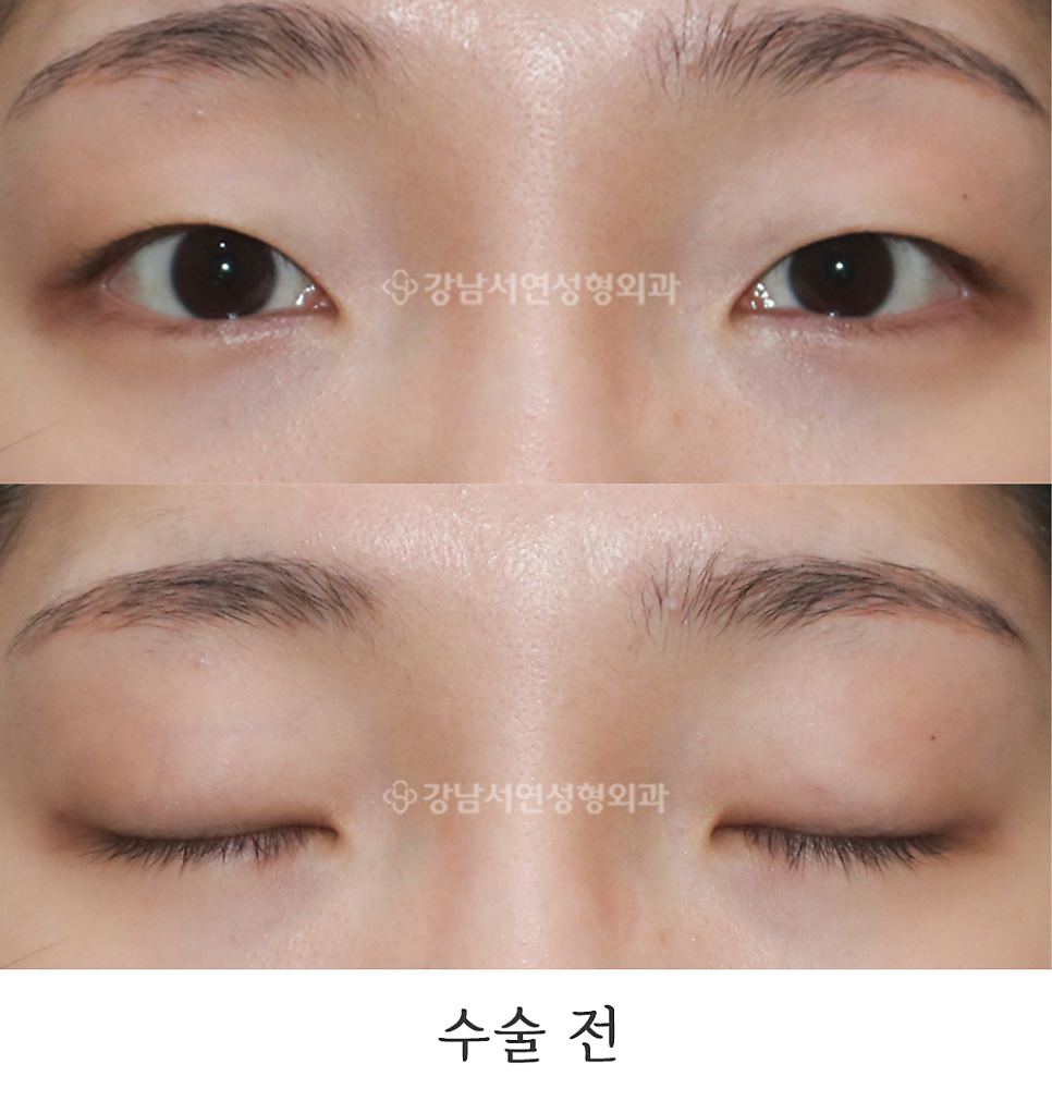 매몰실풀기 수술 전 사진