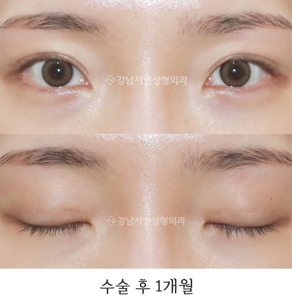 매몰실풀기 수술 후 사진
