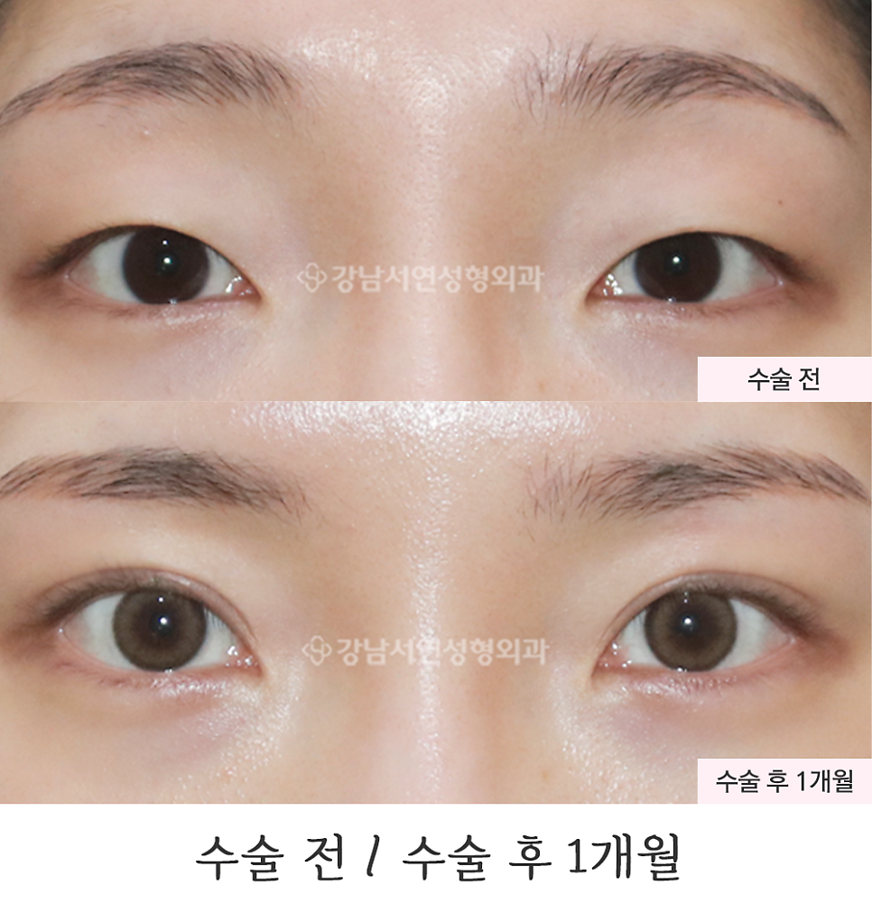 매몰실풀기 수술 전후 비교 사진