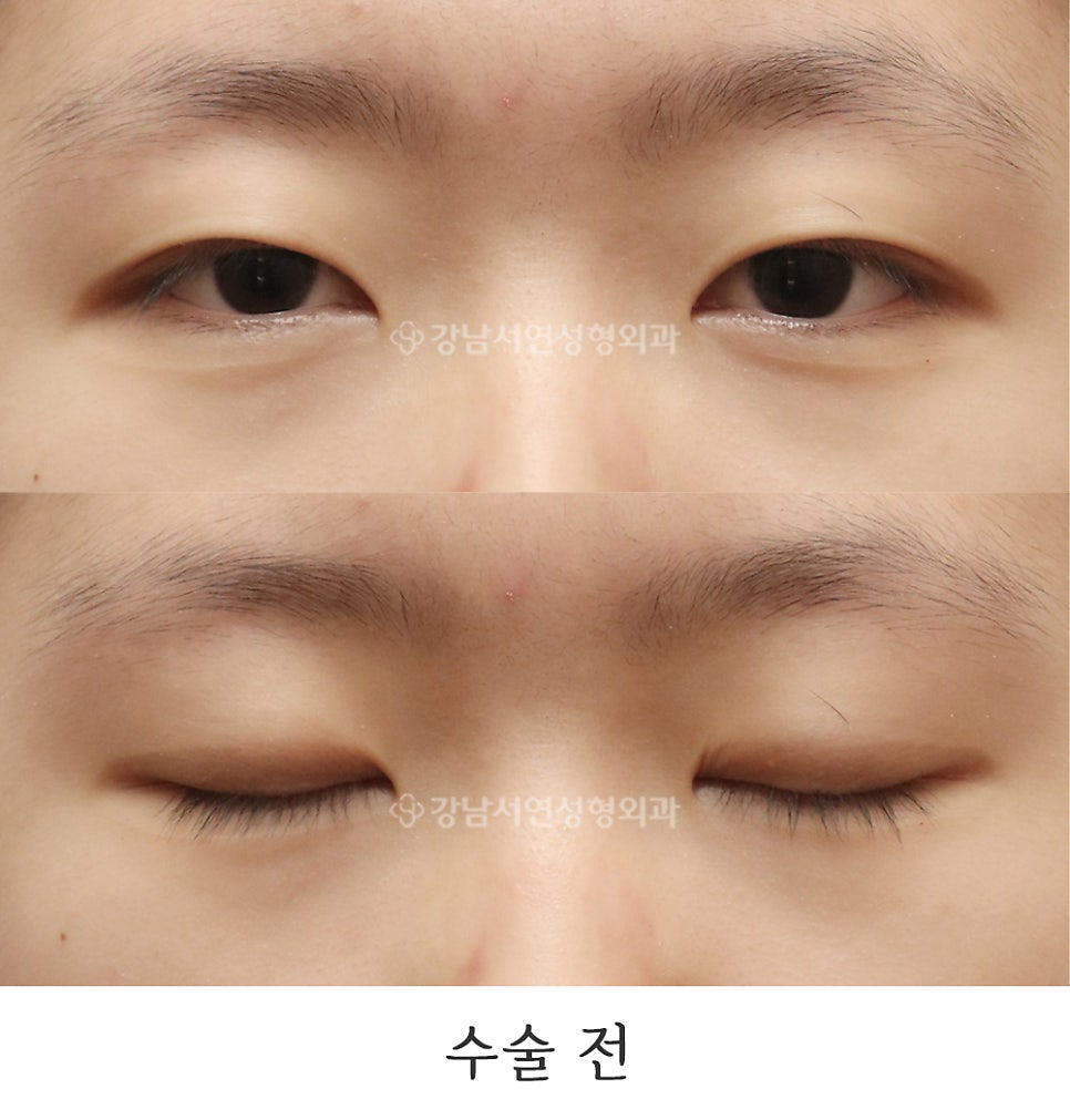 눈매 트임 수술 전 사진