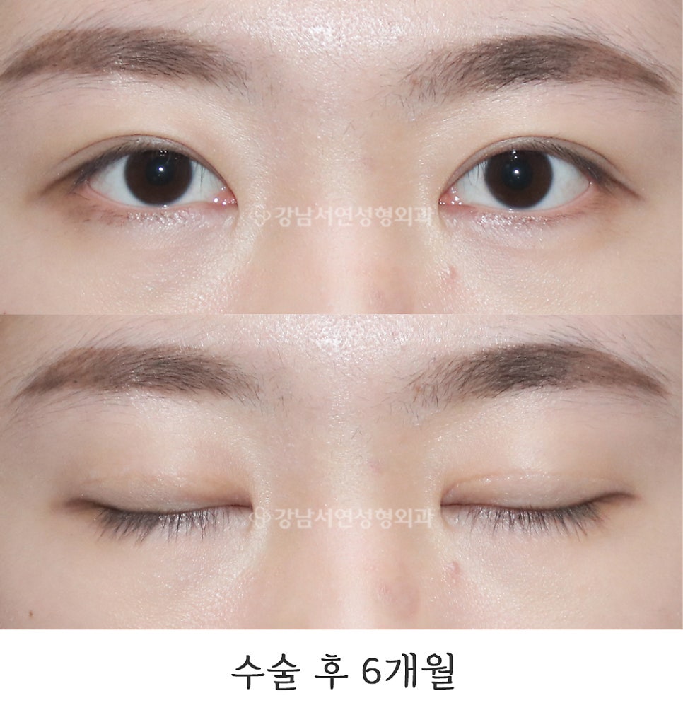 눈매 트임 수술 후 사진