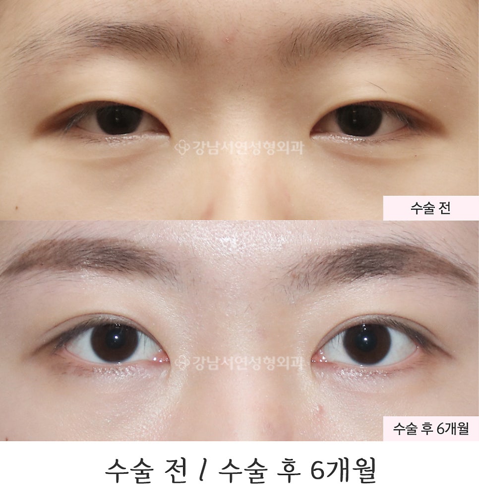 눈매 트임 수술 전후 비교 사진