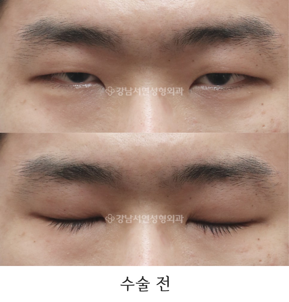 남자 눈성형 수술 전 사진