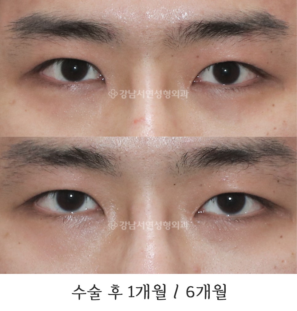 남자 눈성형 수술 전후 비교 사진