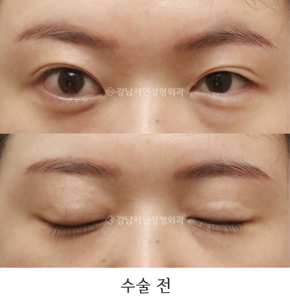 쌍꺼풀 재수술 전 사진