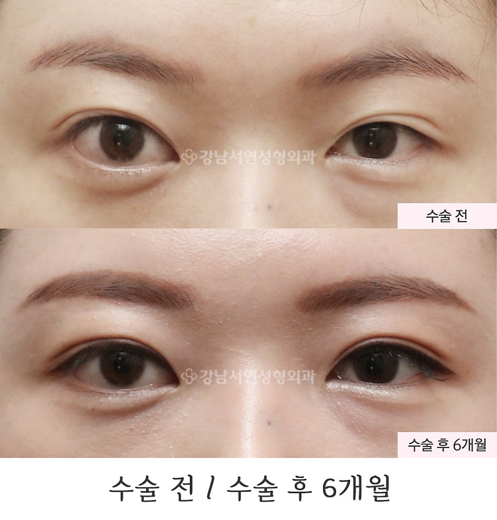 쌍꺼풀 재수술 전후 비교 사진