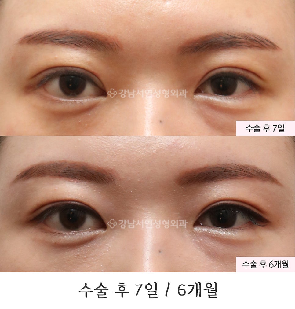 쌍꺼풀 재수술 전후 비교 사진