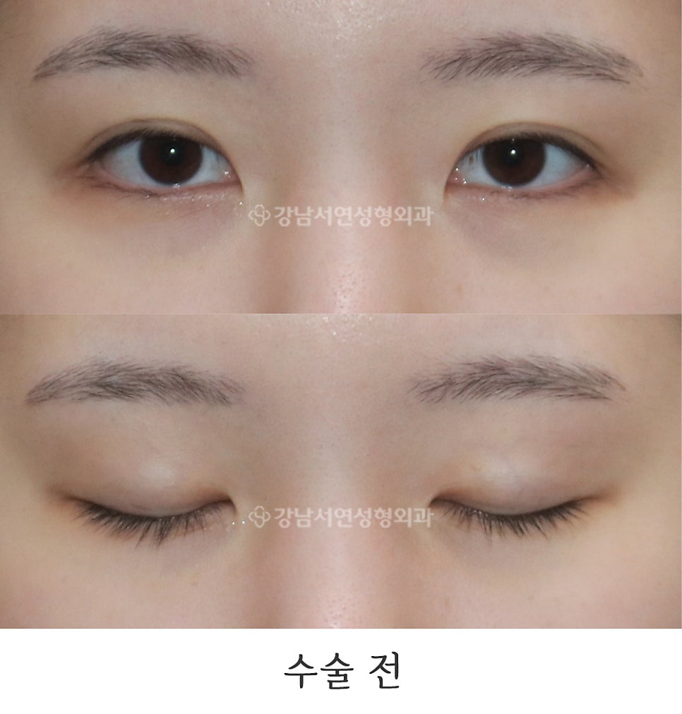 매몰실풀기 수술 전 사진