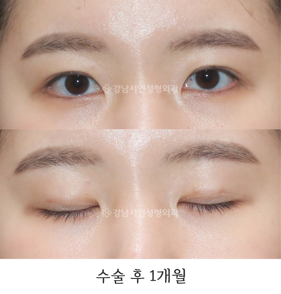 매몰실풀기 수술 후 사진