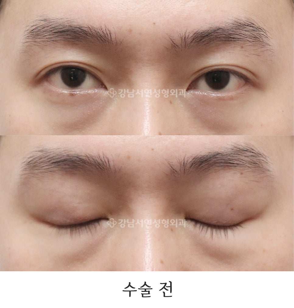 눈매교정 수술 전 사진