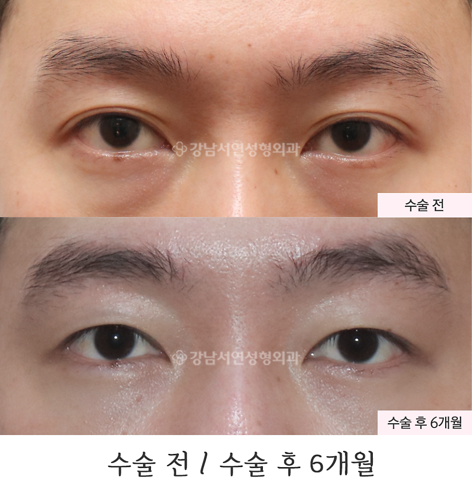 눈매교정 수술 전후 비교 사진