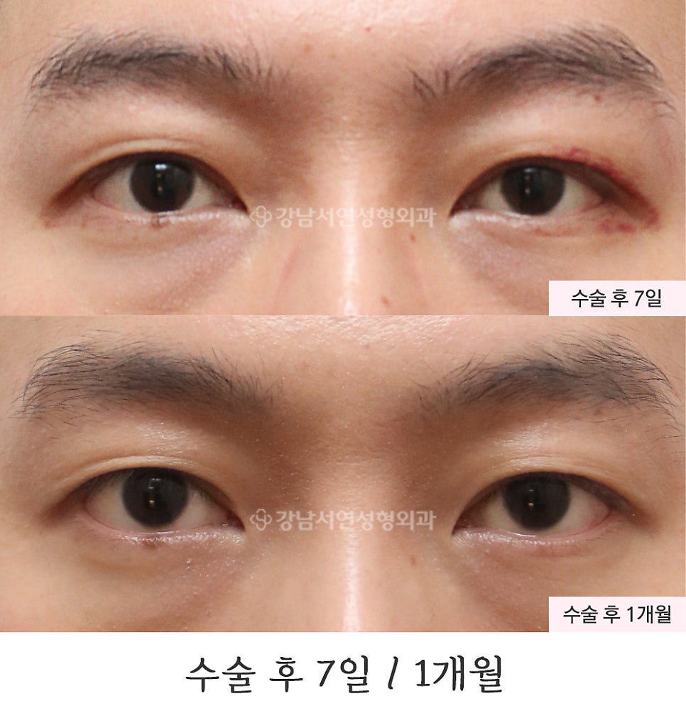 눈매교정 수술 전후 비교 사진