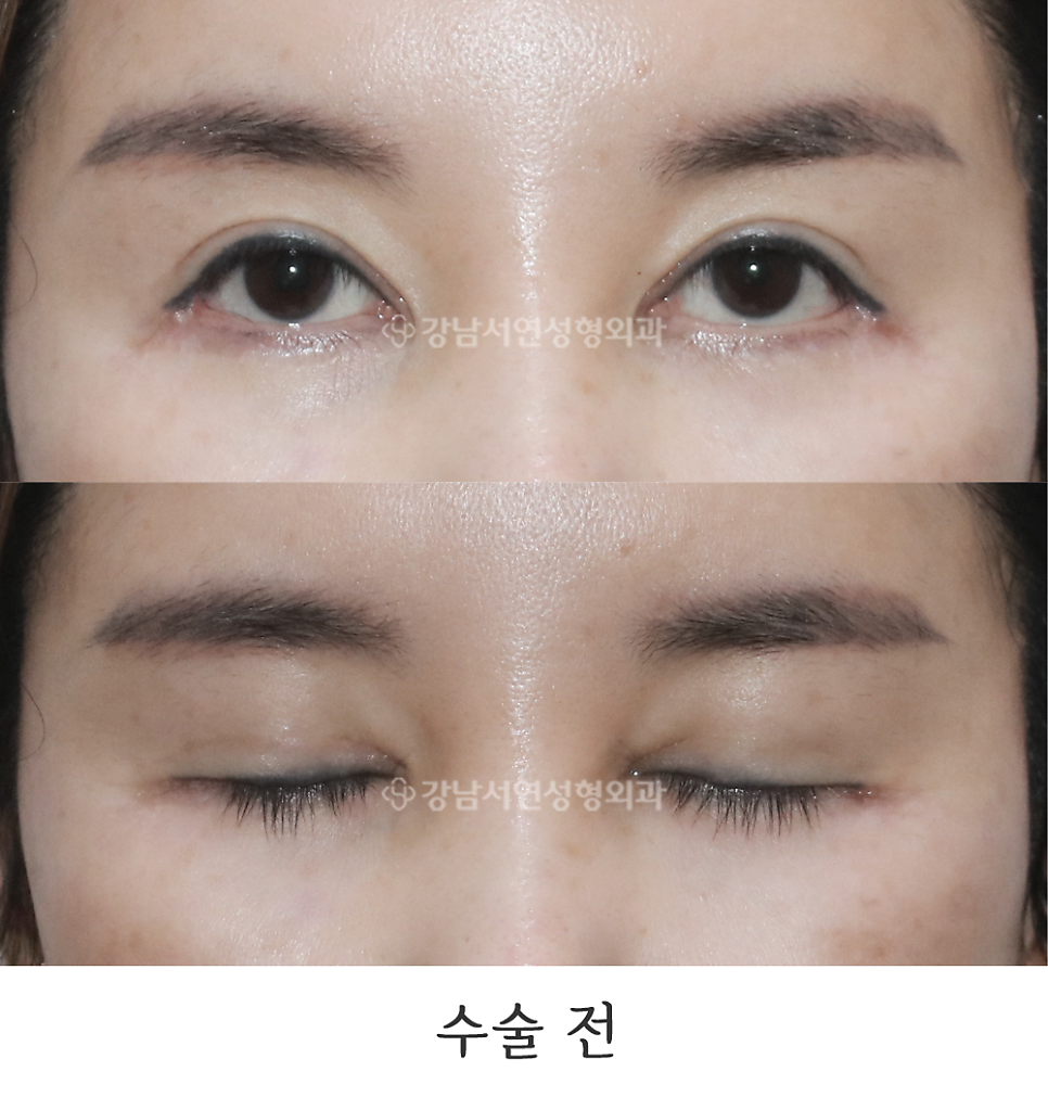 쌍꺼풀 재수술 전 사진