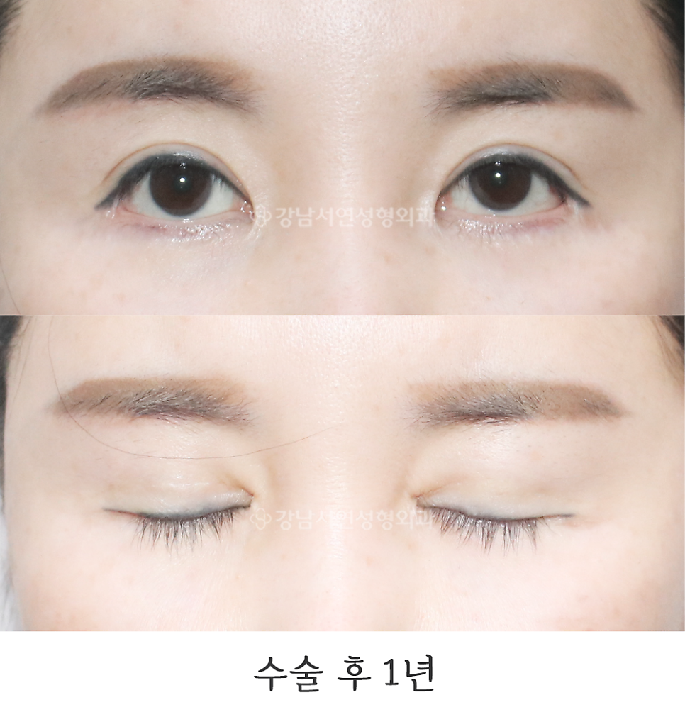 쌍꺼풀 재수술 후 사진