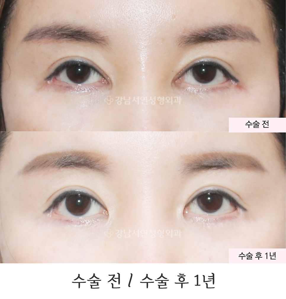 쌍꺼풀 재수술 전후 비교 사진